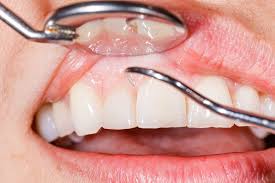 Gum Treatments
